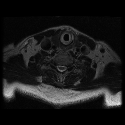 File:Cervical canal stenosis with cord compression (Radiopaedia 34114-35374 Axial T2 15).png