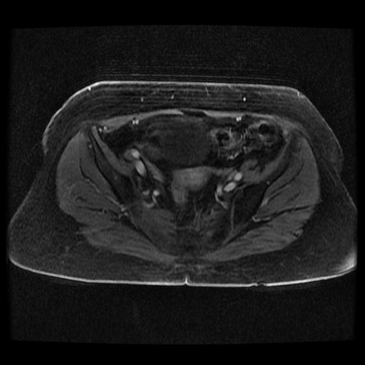 Cervical carcinoma (Radiopaedia 70924-81132 Axial T1 C+ fat sat 150).jpg