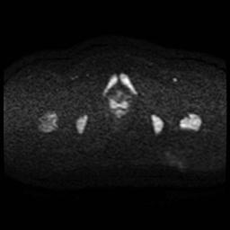 Cervical carcinoma (Radiopaedia 88010-104555 Axial DWI 62).jpg