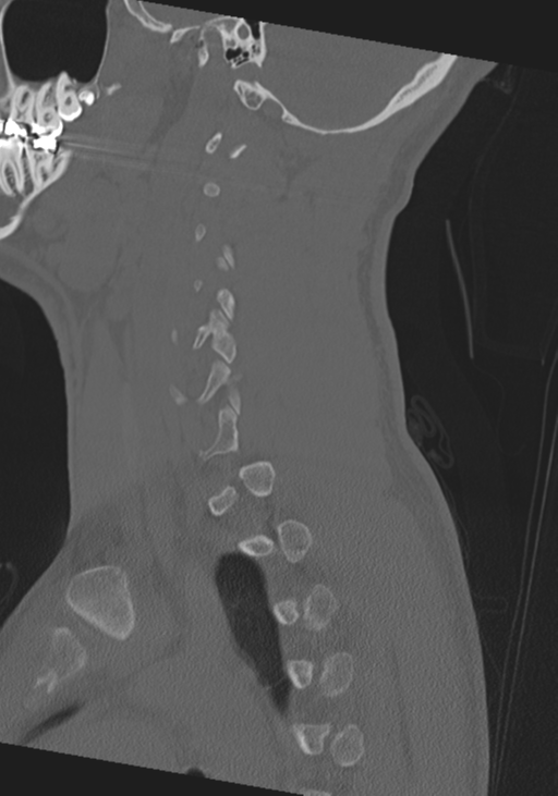 Cervical intercalary bone (Radiopaedia 35211-36748 Sagittal bone window 22).png