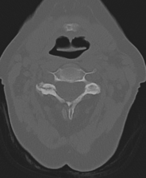 Cervical spine ACDF loosening (Radiopaedia 48998-54071 Axial bone window 23).png