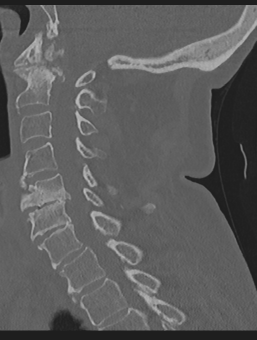 Cervical spondylolysis (Radiopaedia 49616-54811 Sagittal bone window 34).png