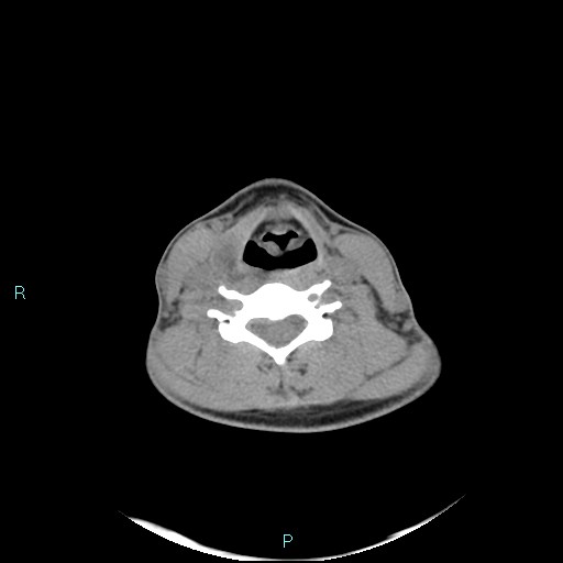 Cervical thymic cyst (Radiopaedia 88632-105335 Axial non-contrast 55).jpg