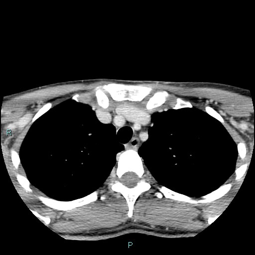 File:Cervical thymic cyst (Radiopaedia 88632-105335 C 11).jpg