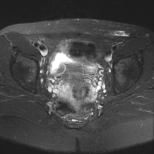File:Cesarian section scar endometriosis (Radiopaedia 66520-75799 Axial T2 fat sat 15).jpg