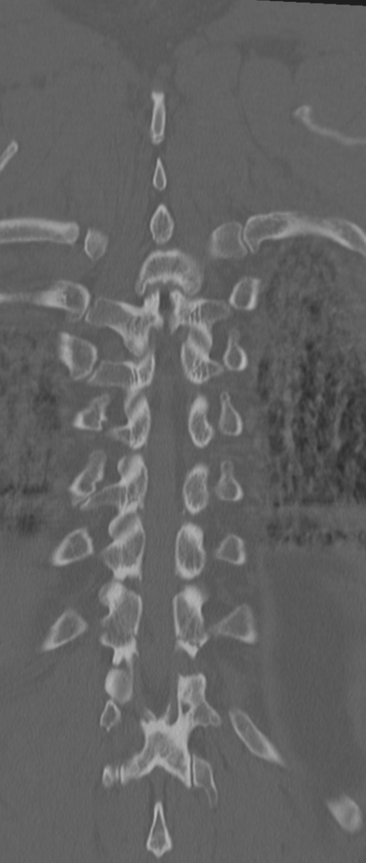 Chance fracture (Radiopaedia 33854-35020 Coronal bone window 67).png