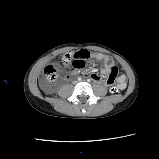 File:Chance fracture with duodenal and pancreatic lacerations (Radiopaedia 43477-46864 A 29).jpg