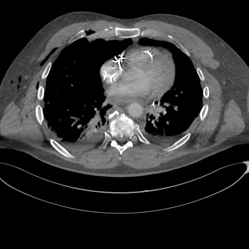 File:Chest multitrauma - aortic injury (Radiopaedia 34708-36147 A 180).png