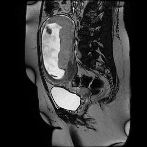 Chiari II malformation - fetal MRI (Radiopaedia 68099-77581 Sagittal Fiesta 34).jpg