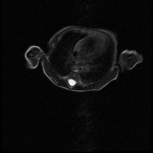 File:Chiari II malformation with spinal meningomyelocele (Radiopaedia 23550-23652 Axial T2 4).jpg