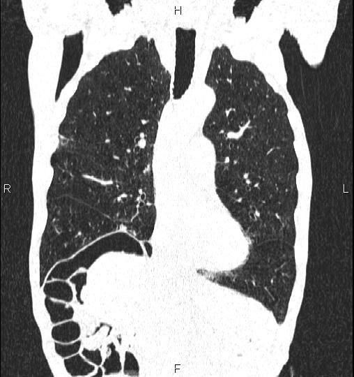 Chilaiditi sign (Radiopaedia 88839-105611 Coronal lung window 25).jpg