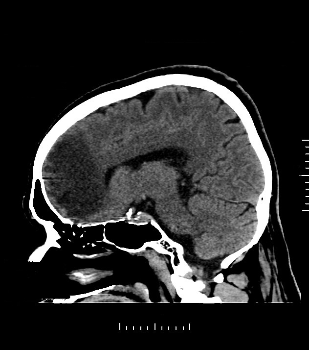 Cholangiocarcinoma with cerebral metastases (Radiopaedia 83519-98628 C 31).jpg