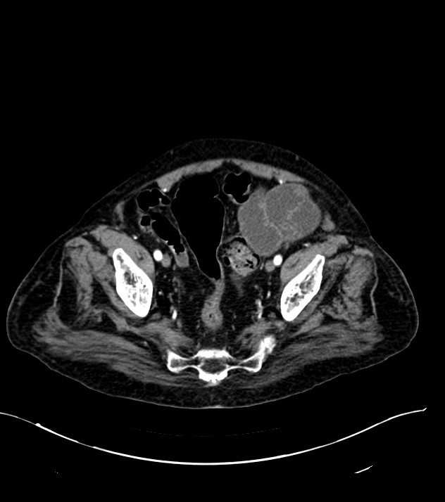 Cholangiocarcinoma with cerebral metastases (Radiopaedia 83519-98629 B 106).jpg