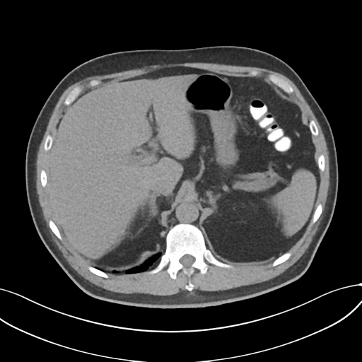 Cholecystitis with focal perforation and hepatic abscess (Radiopaedia 37189-38945 Axial non-contrast 20).png