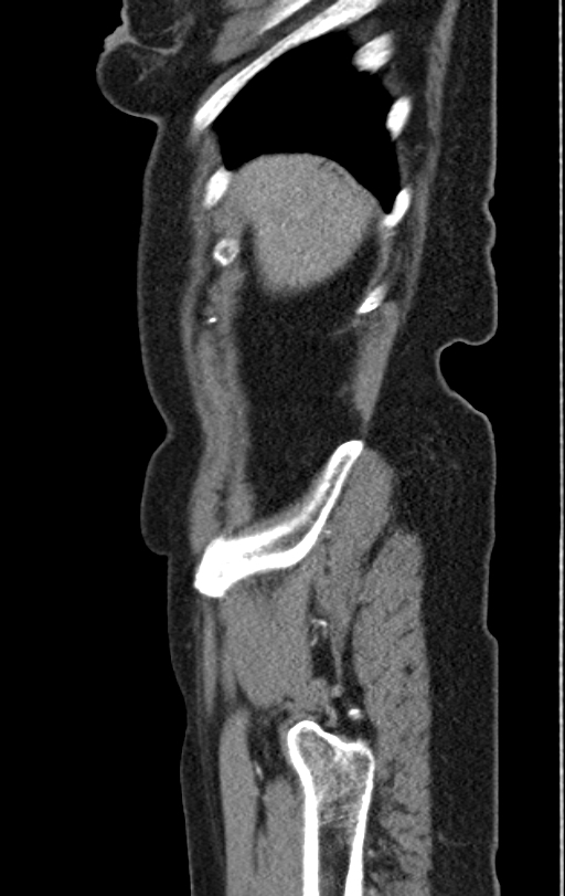 Cholecystoduodenal fistula due to calculous cholecystitis with gallstone migration (Radiopaedia 86875-103077 C 56).jpg