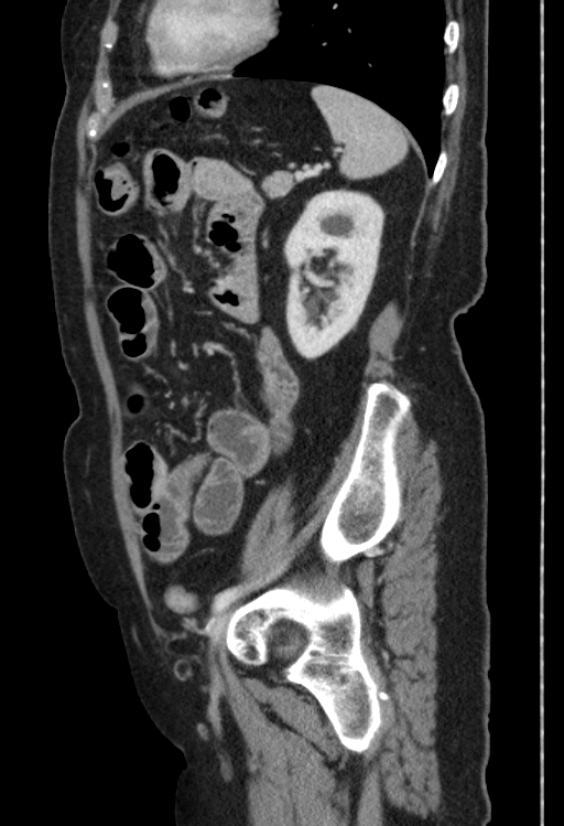 Cholecystoduodenal fistula due to calculous cholecystitis with gallstone migration (Radiopaedia 86875-103077 F 16).jpg