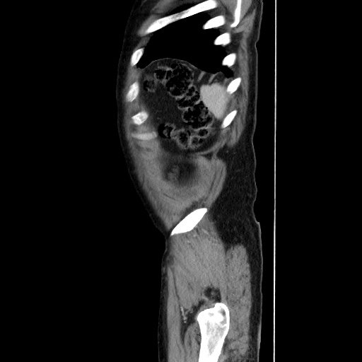 Choledocholiathiasis with normal caliber common bile duct (Radiopaedia 75368-86632 D 141).jpg