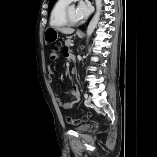 Choledocholiathiasis with normal caliber common bile duct (Radiopaedia 75368-86632 D 96).jpg