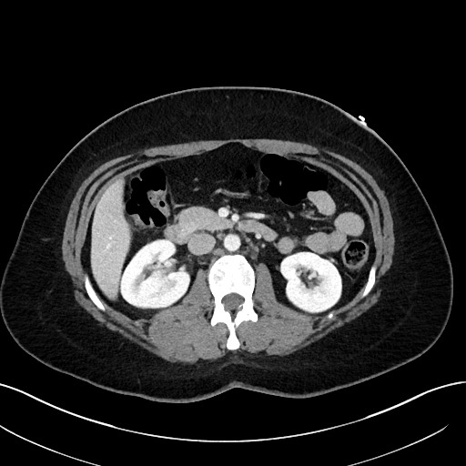 File:Choledocholithiasis after recent cholecystectomy (Radiopaedia 60929-68737 Axial 15).jpg