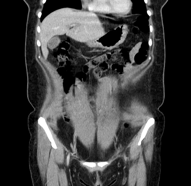 Choledocholithiasis on CT and MRI (Radiopaedia 24825-25087 C 15).jpg