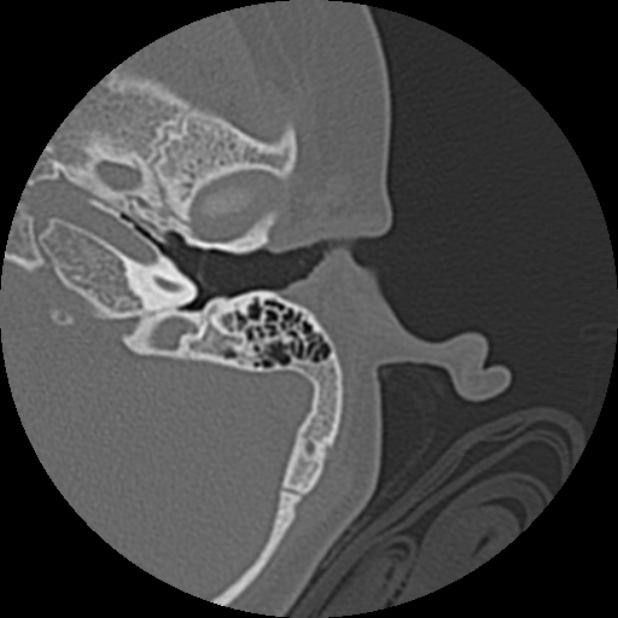 Cholesteatoma (Radiopaedia 73023-83750 Axial Left ear 27).jpg