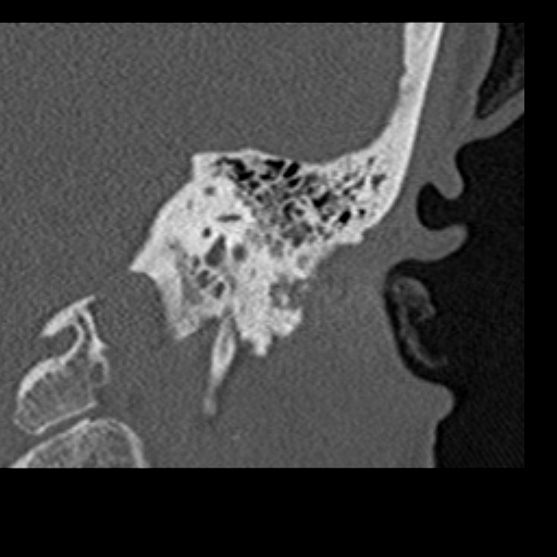 File:Cholesteatoma of the external ear (Radiopaedia 16540-16225 Coronal bone window 18).jpg