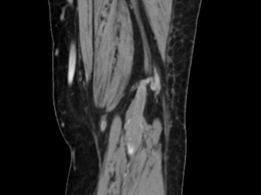 Chondrosarcoma - femur (Radiopaedia 64187-72954 C 56).jpg