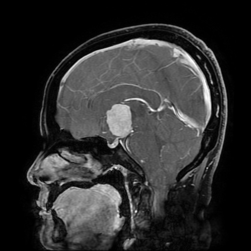 File:Chordoid glioma of third ventricle (Radiopaedia 91612-109340 F 106).jpg
