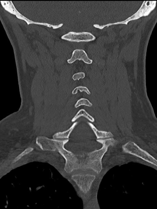 Chordoma (C4 vertebra) (Radiopaedia 47561-52188 Coronal bone window 35).png