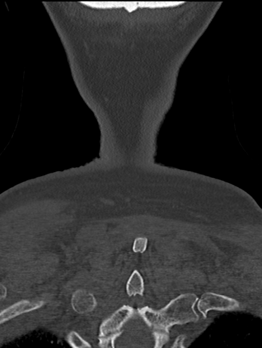 Chordoma (C4 vertebra) (Radiopaedia 47561-52188 Coronal bone window 62).png