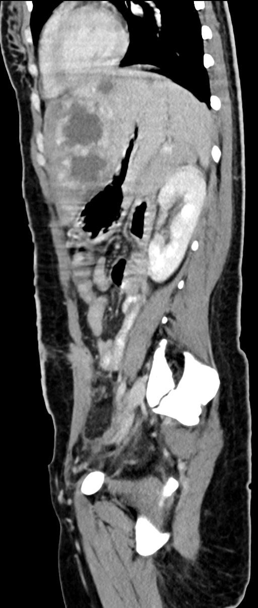 Choriocarcinoma liver metastases (Radiopaedia 74768-85766 C 75).jpg