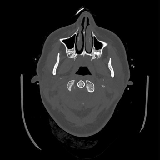 Choroid plexus papilloma extending into the cerebellopontine angle cistern (Radiopaedia 85941-101833 Axial bone window 8).png
