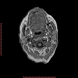 Choroid plexus xanthogranuloma (Radiopaedia 67843-77270 Axial T1 168).jpg