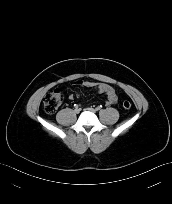 Chromophobe renal cell carcinoma (Radiopaedia 84255-99542 H 37).jpg