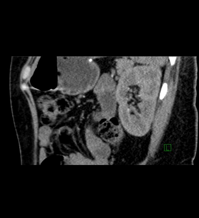 Chromophobe renal cell carcinoma (Radiopaedia 84290-99582 D 26).jpg