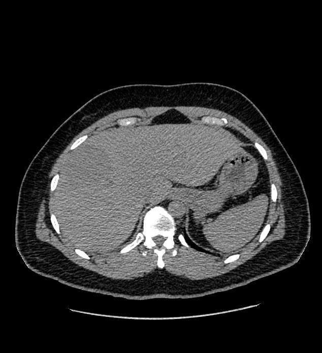 Chromophobe renal cell carcinoma (Radiopaedia 84337-99693 Axial non-contrast 16).jpg