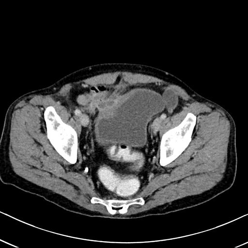 Chronic appendicitis complicated by appendicular abscess, pylephlebitis and liver abscess (Radiopaedia 54483-60700 B 127).jpg