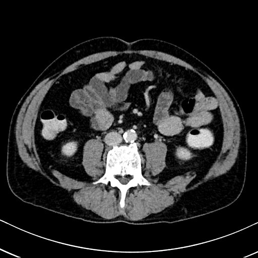 Chronic appendicitis complicated by appendicular abscess, pylephlebitis and liver abscess (Radiopaedia 54483-60700 B 88).jpg
