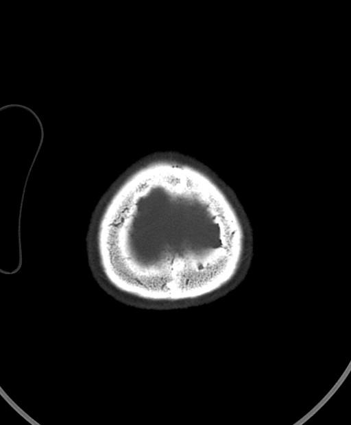 Chronic bilateral subdural hygroma (Radiopaedia 85801-101623 Axial bone window 16).jpg