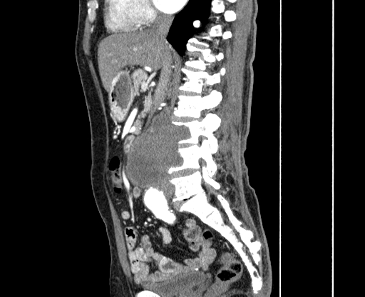 Chronic contained rupture of abdominal aortic aneurysm with extensive erosion of the vertebral bodies (Radiopaedia 55450-61901 B 23).jpg