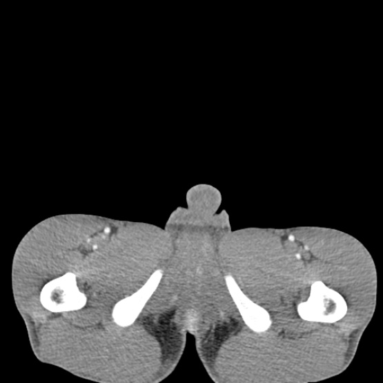 Chronic large bowel pseudo-obstruction (Radiopaedia 43181-46492 A 173).jpg