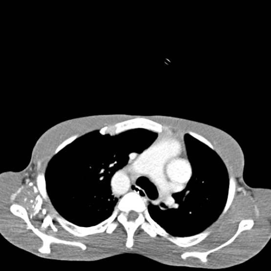 File:Chronic large bowel pseudo-obstruction (Radiopaedia 43181-46492 A 2).jpg