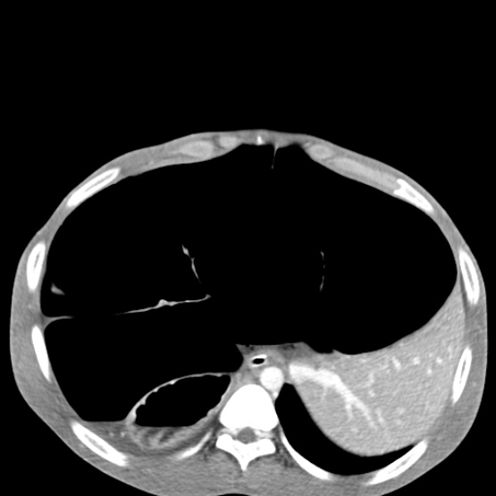 Chronic large bowel pseudo-obstruction (Radiopaedia 43181-46492 A 44).jpg