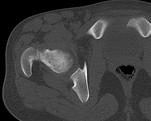 Chronic ostemyelitis of the femur with long sinus tract (Radiopaedia 74947-85982 Axial bone window 4).jpg