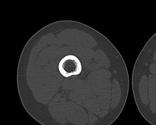 File:Chronic ostemyelitis of the femur with long sinus tract (Radiopaedia 74947-85982 Axial bone window 81).jpg