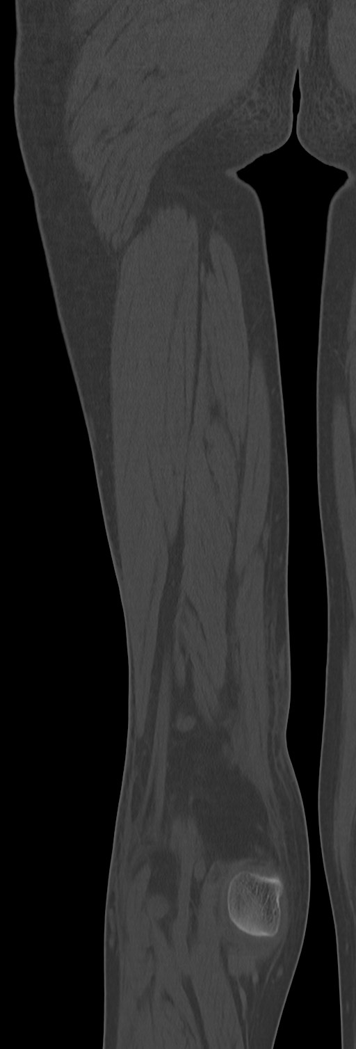 Chronic ostemyelitis of the femur with long sinus tract (Radiopaedia 74947-85982 Coronal bone window 63).jpg