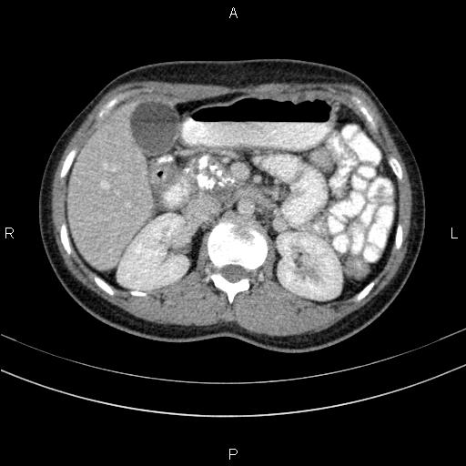 Chronic pancreatitis (Radiopaedia 64576-73450 C 57).jpg