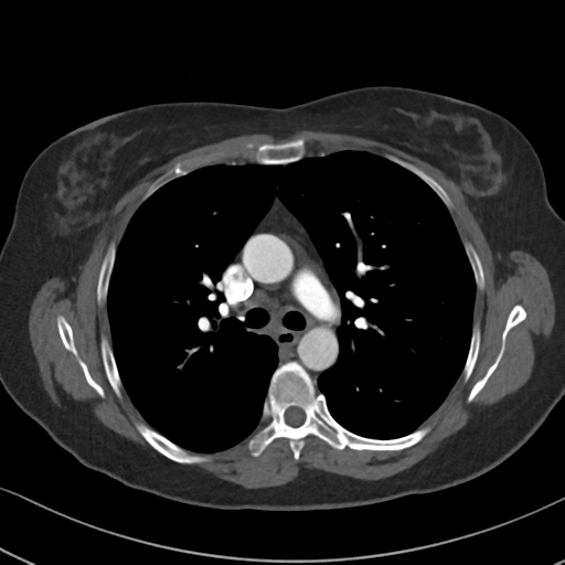 File:Chronic pulmonary embolus (Radiopaedia 39129-41341 Axial C+ CTPA 42).png