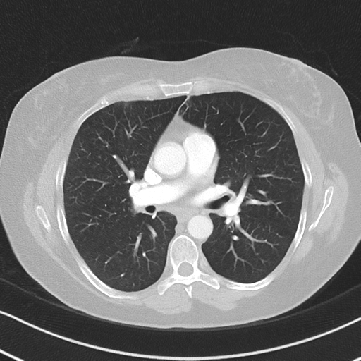 Chronic pulmonary embolus (Radiopaedia 39129-41341 Axial lung window 31).png