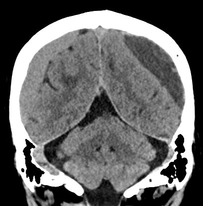 Chronic subdural hematomas (Radiopaedia 66577-75885 Coronal non-contrast 45).jpg